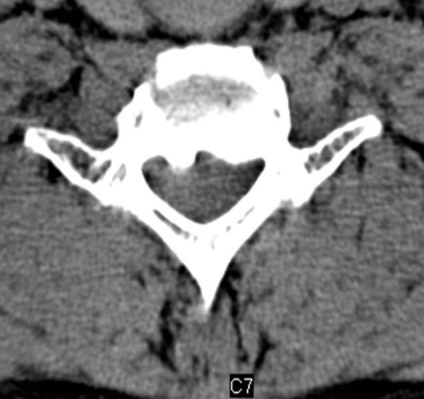 Tomografia computerizată în diagnosticul bolilor neoplazice ale coloanei vertebrale