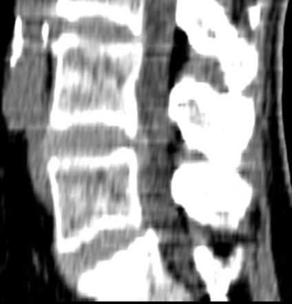 Tomografia computerizată în diagnosticul bolilor neoplazice ale coloanei vertebrale