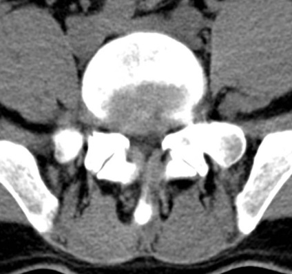 Tomografia computerizată în diagnosticul bolilor neoplazice ale coloanei vertebrale