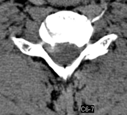 Tomografia computerizată în diagnosticul bolilor neoplazice ale coloanei vertebrale