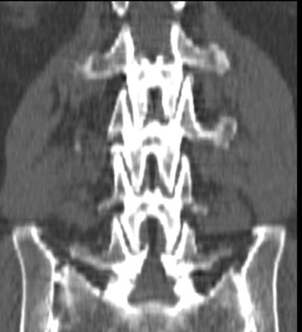 Tomografia computerizată în diagnosticul bolilor neoplazice ale coloanei vertebrale