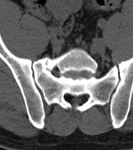 Tomografia computerizată în diagnosticul bolilor neoplazice ale coloanei vertebrale