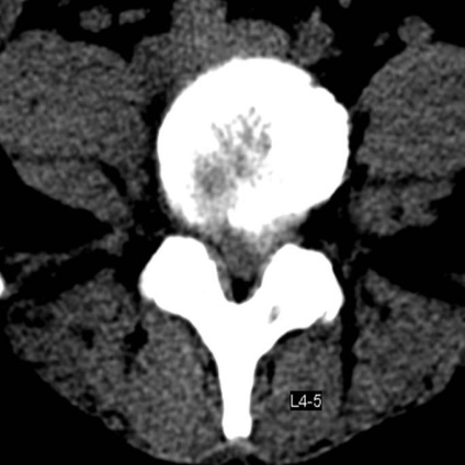 Tomografia computerizată în diagnosticul bolilor neoplazice ale coloanei vertebrale