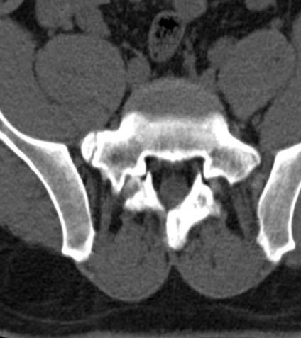 Tomografia computerizată în diagnosticul bolilor neoplazice ale coloanei vertebrale