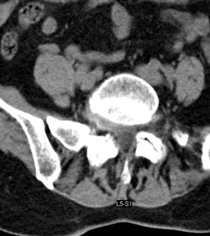 Tomografia computerizată în diagnosticul bolilor neoplazice ale coloanei vertebrale