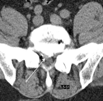 Tomografia computerizată în diagnosticul bolilor neoplazice ale coloanei vertebrale