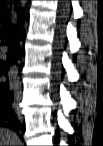 Tomografia computerizată în diagnosticul bolilor neoplazice ale coloanei vertebrale