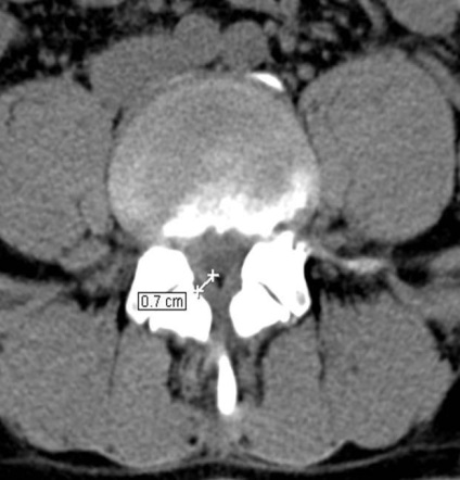 Tomografia computerizată în diagnosticul bolilor neoplazice ale coloanei vertebrale