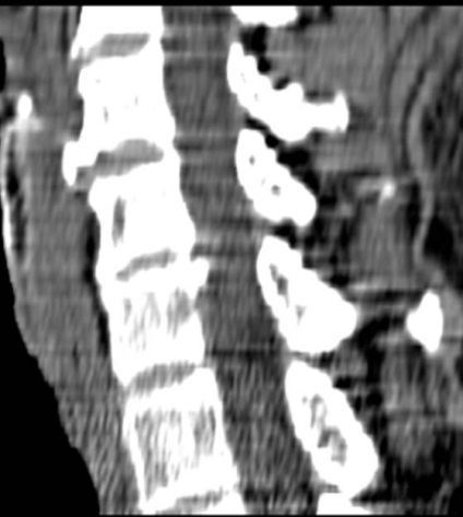 Tomografia computerizată în diagnosticul bolilor neoplazice ale coloanei vertebrale