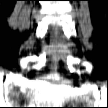 Tomografia computerizată în diagnosticul bolilor neoplazice ale coloanei vertebrale