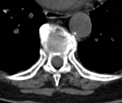 Tomografia computerizată în diagnosticul bolilor neoplazice ale coloanei vertebrale