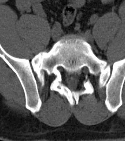 Tomografia computerizată în diagnosticul bolilor neoplazice ale coloanei vertebrale