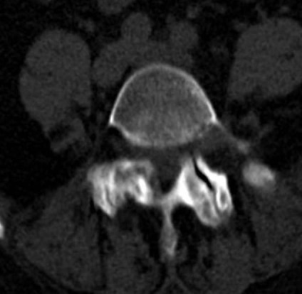 Tomografia computerizată în diagnosticul bolilor neoplazice ale coloanei vertebrale