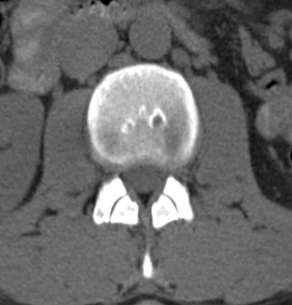 Tomografia computerizată în diagnosticul bolilor neoplazice ale coloanei vertebrale