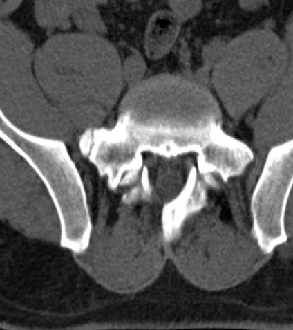 Tomografia computerizată în diagnosticul bolilor neoplazice ale coloanei vertebrale