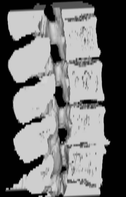 Tomografia computerizată în diagnosticul bolilor neoplazice ale coloanei vertebrale