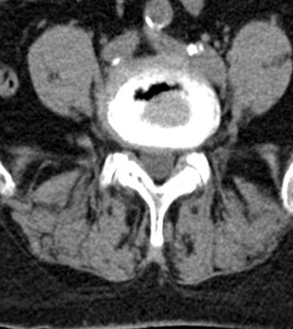 Tomografia computerizată în diagnosticul bolilor neoplazice ale coloanei vertebrale