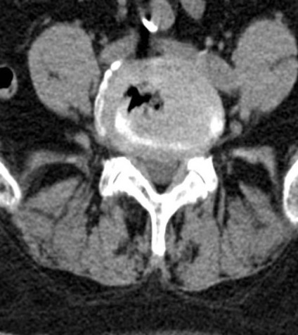 Tomografia computerizată în diagnosticul bolilor neoplazice ale coloanei vertebrale