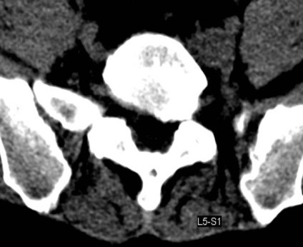 Tomografia computerizată în diagnosticul bolilor neoplazice ale coloanei vertebrale