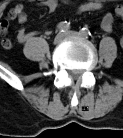 Tomografia computerizată în diagnosticul bolilor neoplazice ale coloanei vertebrale