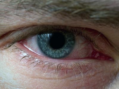 Ochii roșii - ce să faceți, cum să curățați după lipsa de somn, oboseală, boală