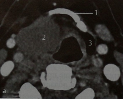 Laryngocele - tumori ale laringelui