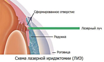 Iridectomia bazală laser cu glaucom - cum este operația de îndepărtare, postoperator