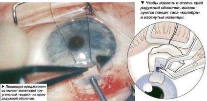 Iridectomia bazală laser cu glaucom - cum este operația de îndepărtare, postoperator