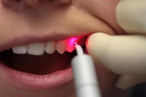 Curățarea dinților laser - apelul unui zâmbet radiant - despre corecția mușcăturii și a bretelelor