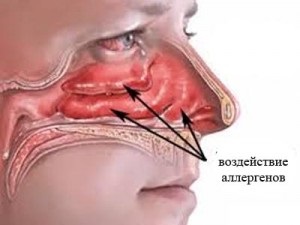 Allergiás rhinitis kezelése népi gyógymódokkal - gyógyítók receptjei