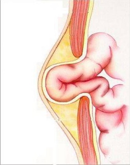 Tratamentul unei hernie a peretelui abdominal anterior, îndepărtarea herniilor