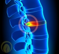 Tratamentul herniilor spinale fără intervenție chirurgicală, tratamentul herniilor discului intervertebral