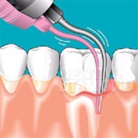 Tratamentul bolii parodontale (metode moderne) - cum să tratați eficient parodontita