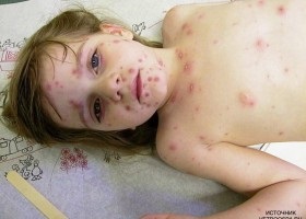 Tratamentul varicelei la copii sau ceea ce ar trebui să facă părinții