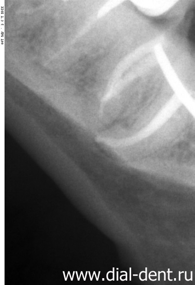 Tratamentul canalelor dentare și extragerea unui fragment al instrumentului din canalul dintelui