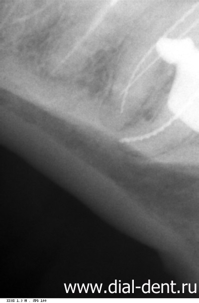 Tratamentul canalelor dentare și extragerea unui fragment al instrumentului din canalul dintelui