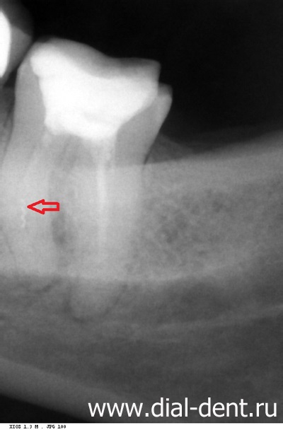 Tratamentul canalelor dentare și extragerea unui fragment al instrumentului din canalul dintelui