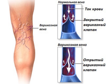 Vena de pe picior nu a reușit să facă ce, cauzele, simptomele caracteristice