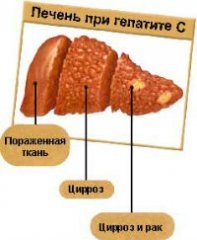 Diagnosticul radiologic al hepatitei