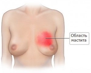 Măști (inflamația sânului) la o mamă care alăptează