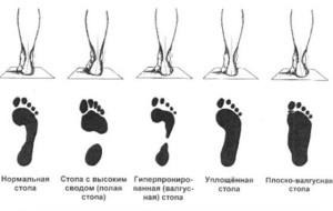 Metode de prevenire a picioarelor plate în copiii preșcolari