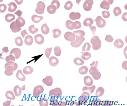 Anemie hemolitică microangiopatică - istoric al studiului, cauze