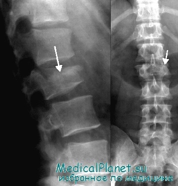 Răniți de coloana vertebrală