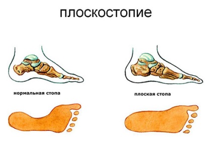 Ортопедични стелки как да изберете напречен и надлъжен плосък