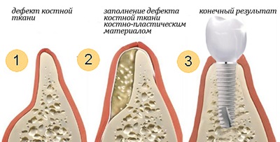 Materiale pentru osteosubstituție și utilizarea lor în plasticul osos