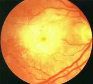 A szem retinájának akut nekrózisát, kezelését, okait, tüneteit