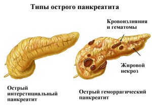 Akut pancreatitis - okok, tünetek, kezelés