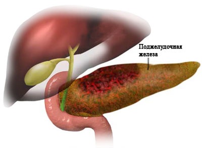 Akut pancreatitis - okok, tünetek, kezelés