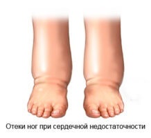 Umflarea picioarelor, principalele cauze, tratament și prevenire