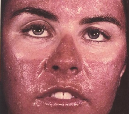 A pattanások és a szalicilsav gyógyszere után arccal égeti a bőrt